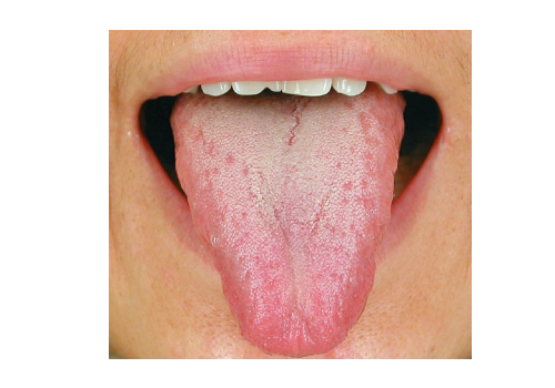 Liver Qi Stagnation tongue