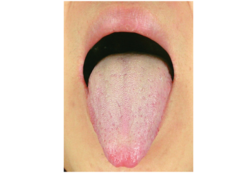 Liver Qi Stagnation tongue