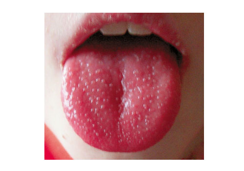 Yin deficiency tongue